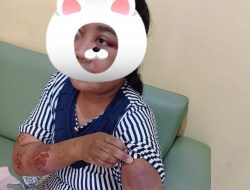 ART Cilacap Alami Penyiksaan dari Majikan di Yogya