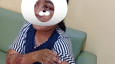 ART Cilacap Alami Penyiksaan dari Majikan di Yogya